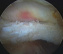 Iliopsoas Tendonitis