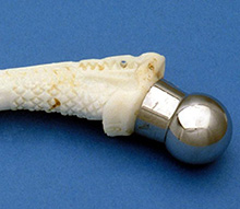 Isoelastic Prosthesis