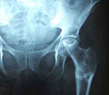 Avascular Necrosis of the Hip