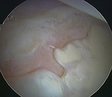 Bare bone exposed due to osteoarthritis