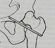 Brittain’s extra-articular arthrodesis