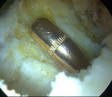 A bullet in the hip!