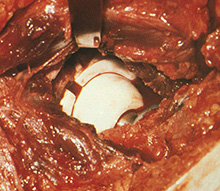 Ceramic on Ceramic Total Hip Replacement