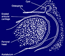 Diagram of OA Hip