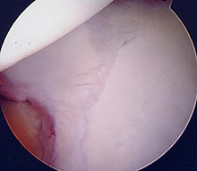 Fracture of the acetabulum