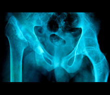 Girdlestone plus Arthrodesis