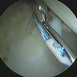 Repairing a torn acetabular labrum