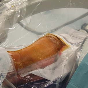 A patient prepared and positioned for a hip arthroscopy. The head is to the left and the feet to the right. We are standing at the back of the patient.