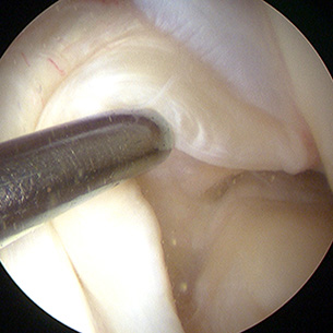 Left Knee arthroscopy - Stretched out and incompetent ACL being tested at the time of arthroscopy.