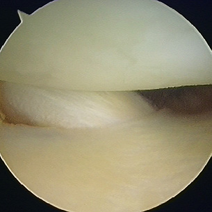 Small tendon at the back of the knee, the popliteus tendon, frequently seen at knee arthroscopy. It can occasionally tear.