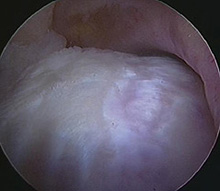 Large impingement lesion