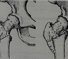 McMurray Osteotomy