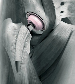 Microplasty