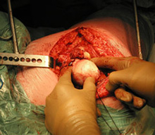 Operative photograph of and Osteoarthritic Hip