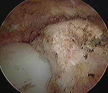 Osteoarthritis of the hip