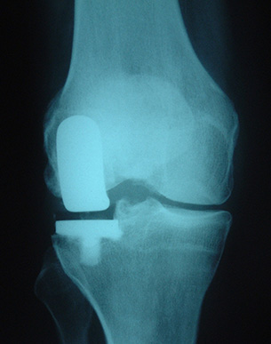 Partial Knee Replacement