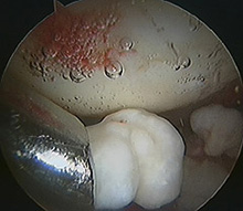 Removing a loose body from the hip