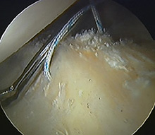 Repairing the labrum