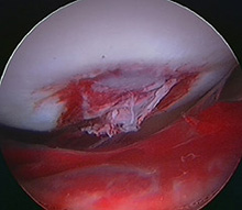 Ruptured Ligamentum Teres