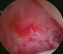 Synovitis – inflammation of the hip lining