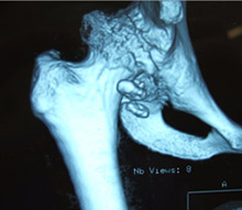 Three Dimensions CT Scan of Gross OA