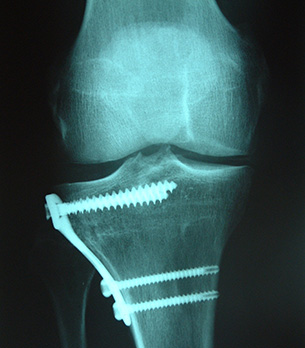 Tibial Osteotomy