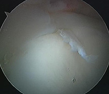 Torn Acetabular Labrum