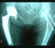 36mm Total Hip Replacement