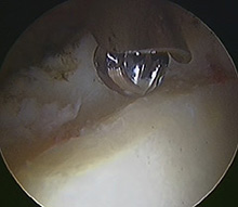 Dealing with pincer impingement – burring away part of the acetabular margin
