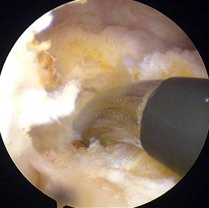 Radiofrequency probe in use at the back of the knee during arthroscopic PCL reconstruction.