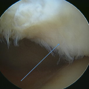Left Knee arthroscopy